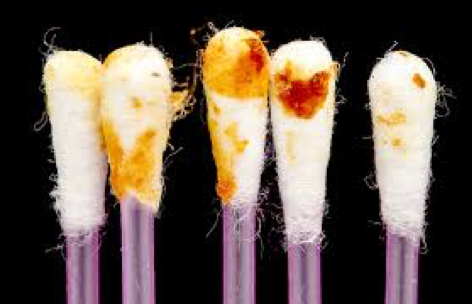 Different Types of Earwax