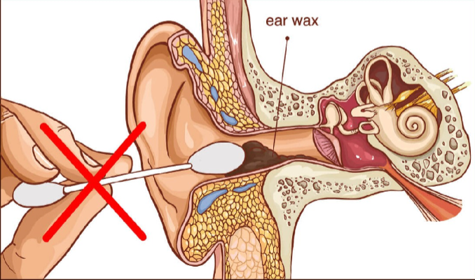 Why Earwax Buildup Happens and How to Prevent It